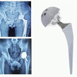 מוט טיטניום להחלפה תותבת עצם עצם